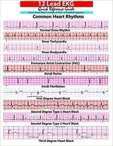 12 lead EKG Pocket Card - APRN world